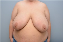 Breast Reduction Before Photo by Carlos Rivera-Serrano, MD; Bay Harbour Islands, FL - Case 43644