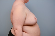 Breast Reduction After Photo by Carlos Rivera-Serrano, MD; Bay Harbour Islands, FL - Case 43644