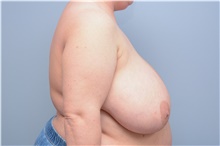 Breast Reduction Before Photo by Carlos Rivera-Serrano, MD; Bay Harbour Islands, FL - Case 43644