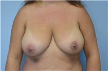 Breast Reduction Before Photo by Carlos Rivera-Serrano, MD; Bay Harbour Islands, FL - Case 43645