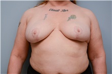 Breast Reduction After Photo by Carlos Rivera-Serrano, MD; Bay Harbour Islands, FL - Case 43646