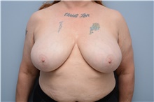 Breast Reduction Before Photo by Carlos Rivera-Serrano, MD; Bay Harbour Islands, FL - Case 43646
