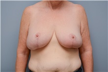Breast Reduction After Photo by Carlos Rivera-Serrano, MD; Bay Harbour Islands, FL - Case 43648