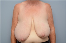 Breast Reduction Before Photo by Carlos Rivera-Serrano, MD; Bay Harbour Islands, FL - Case 43648