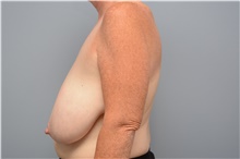 Breast Reduction Before Photo by Carlos Rivera-Serrano, MD; Bay Harbour Islands, FL - Case 43648