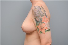 Breast Reduction After Photo by Carlos Rivera-Serrano, MD; Bay Harbour Islands, FL - Case 43649