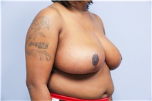 Breast Reduction After Photo by Carlos Rivera-Serrano, MD; Bay Harbour Islands, FL - Case 43651