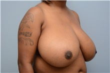 Breast Reduction Before Photo by Carlos Rivera-Serrano, MD; Bay Harbour Islands, FL - Case 43651