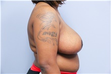 Breast Reduction After Photo by Carlos Rivera-Serrano, MD; Bay Harbour Islands, FL - Case 43651