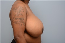 Breast Reduction Before Photo by Carlos Rivera-Serrano, MD; Bay Harbour Islands, FL - Case 43651