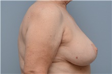 Breast Reduction After Photo by Carlos Rivera-Serrano, MD; Bay Harbour Islands, FL - Case 43652