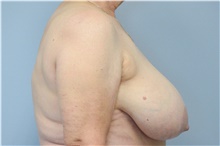 Breast Reduction Before Photo by Carlos Rivera-Serrano, MD; Bay Harbour Islands, FL - Case 43652