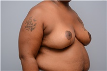Breast Reduction After Photo by Carlos Rivera-Serrano, MD; Bay Harbour Islands, FL - Case 43653