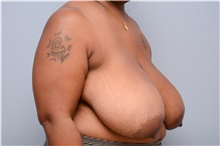 Breast Reduction Before Photo by Carlos Rivera-Serrano, MD; Bay Harbour Islands, FL - Case 43653
