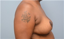 Breast Reduction After Photo by Carlos Rivera-Serrano, MD; Bay Harbour Islands, FL - Case 43653