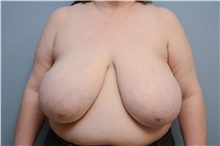 Breast Reduction Before Photo by Carlos Rivera-Serrano, MD; Bay Harbour Islands, FL - Case 43654