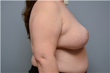 Breast Reduction After Photo by Carlos Rivera-Serrano, MD; Bay Harbour Islands, FL - Case 43654