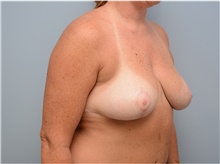 Breast Reduction After Photo by Carlos Rivera-Serrano, MD; Bay Harbour Islands, FL - Case 43655