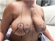 Breast Reduction Before Photo by Carlos Rivera-Serrano, MD; Bay Harbour Islands, FL - Case 43655