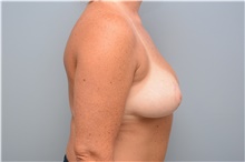 Breast Reduction After Photo by Carlos Rivera-Serrano, MD; Bay Harbour Islands, FL - Case 43655