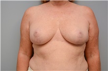 Breast Reduction After Photo by Carlos Rivera-Serrano, MD; Bay Harbour Islands, FL - Case 43656