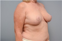 Breast Reduction After Photo by Carlos Rivera-Serrano, MD; Bay Harbour Islands, FL - Case 43656
