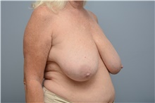 Breast Reduction Before Photo by Carlos Rivera-Serrano, MD; Bay Harbour Islands, FL - Case 43656