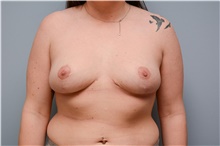 Breast Reduction After Photo by Carlos Rivera-Serrano, MD; Bay Harbour Islands, FL - Case 43658