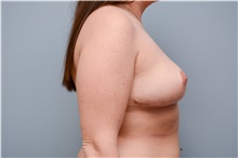 Breast Reduction After Photo by Carlos Rivera-Serrano, MD; Bay Harbour Islands, FL - Case 43658