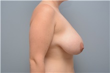 Breast Reduction Before Photo by Carlos Rivera-Serrano, MD; Bay Harbour Islands, FL - Case 43658