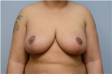 Breast Reduction After Photo by Carlos Rivera-Serrano, MD; Carbondale, IL - Case 43660
