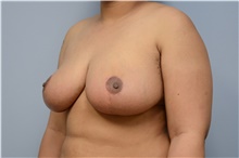 Breast Reduction After Photo by Carlos Rivera-Serrano, MD; Bay Harbour Islands, FL - Case 43660