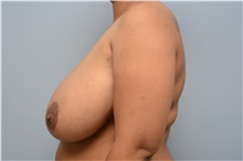 Breast Reduction Before Photo by Carlos Rivera-Serrano, MD; Bay Harbour Islands, FL - Case 43660
