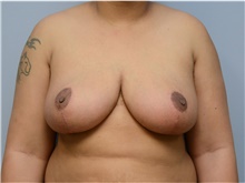 Breast Reduction After Photo by Carlos Rivera-Serrano, MD; Bay Harbour Islands, FL - Case 43660