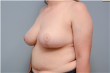 Breast Reduction After Photo by Carlos Rivera-Serrano, MD; Bay Harbour Islands, FL - Case 43661