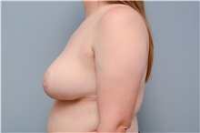 Breast Reduction After Photo by Carlos Rivera-Serrano, MD; Bay Harbour Islands, FL - Case 43661