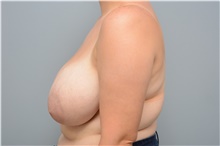 Breast Reduction Before Photo by Carlos Rivera-Serrano, MD; Bay Harbour Islands, FL - Case 43661