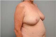 Breast Reduction After Photo by Carlos Rivera-Serrano, MD; Bay Harbour Islands, FL - Case 43662
