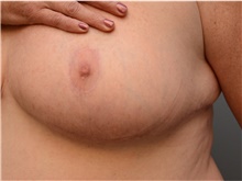 Breast Reduction After Photo by Carlos Rivera-Serrano, MD; Bay Harbour Islands, FL - Case 43662