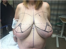 Breast Reduction Before Photo by Carlos Rivera-Serrano, MD; Bay Harbour Islands, FL - Case 43662