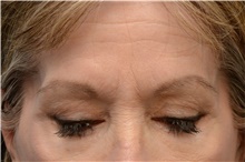 Brow Lift Before Photo by Carlos Rivera-Serrano, MD; Bay Harbour Islands, FL - Case 43670