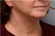 Chin Augmentation After Photo by Carlos Rivera-Serrano, MD; Bay Harbour Islands, FL - Case 43671