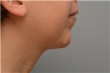 Chin Augmentation After Photo by Carlos Rivera-Serrano, MD; Carbondale, IL - Case 43672