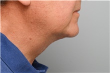 Chin Augmentation After Photo by Carlos Rivera-Serrano, MD; Carbondale, IL - Case 43673