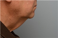 Chin Augmentation Before Photo by Carlos Rivera-Serrano, MD; Carbondale, IL - Case 43673