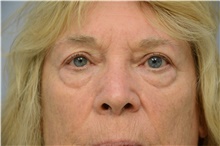 Eyelid Ptosis Repair After Photo by Carlos Rivera-Serrano, MD; Bay Harbour Islands, FL - Case 43674