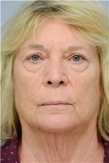 Eyelid Ptosis Repair After Photo by Carlos Rivera-Serrano, MD; Bay Harbour Islands, FL - Case 43674
