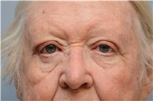 Eyelid Ptosis Repair After Photo by Carlos Rivera-Serrano, MD; Bay Harbour Islands, FL - Case 43675