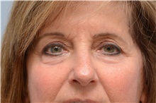 Eyelid Ptosis Repair After Photo by Carlos Rivera-Serrano, MD; Bay Harbour Islands, FL - Case 43676