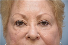 Eyelid Ptosis Repair After Photo by Carlos Rivera-Serrano, MD; Bay Harbour Islands, FL - Case 43677